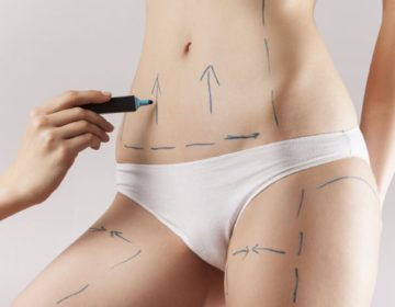 H νέα τεχνική λιποαναρρόφησης για οριστικά αποτελέσματα