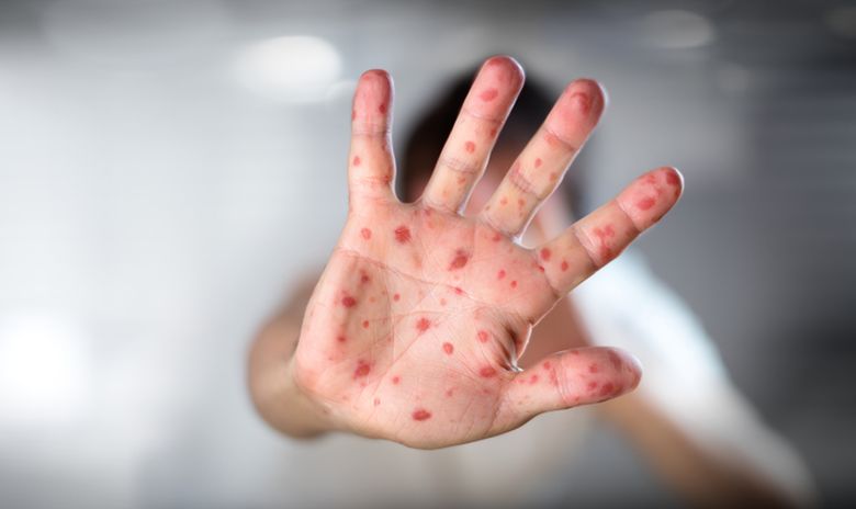 Ποιοι κινδυνεύουν από την ιλαρά και πώς θα προστατευθούν