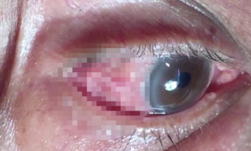 Γιατρός έβγαλε από μάτι ασθενή σκουλήκι 15 εκατοστών!