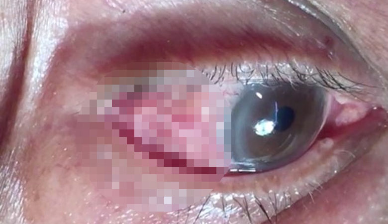 Γιατρός έβγαλε από μάτι ασθενή σκουλήκι 15 εκατοστών!