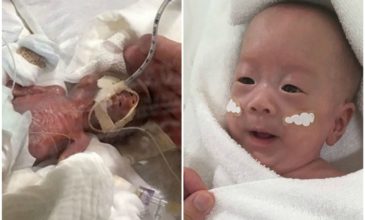 Το μικρότερο αγόρι στο κόσμο που γεννήθηκε 268 γραμμάρια έγινε 5 μηνών