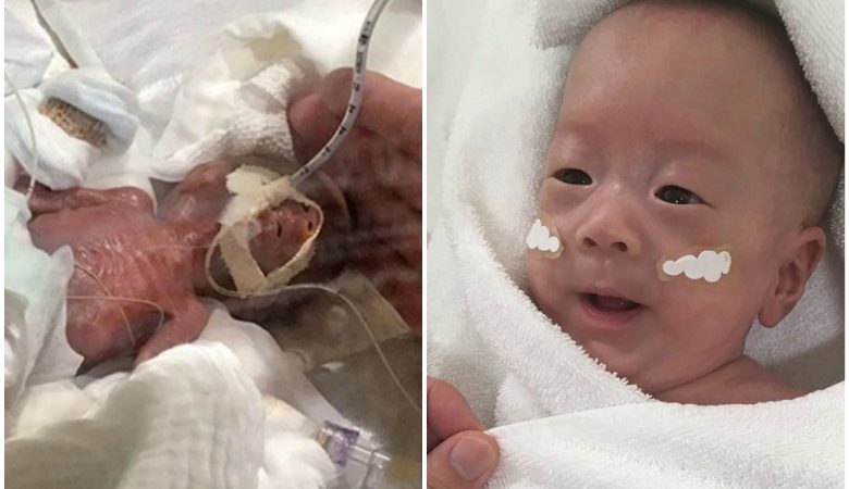 Το μικρότερο αγόρι στο κόσμο που γεννήθηκε 268 γραμμάρια έγινε 5 μηνών
