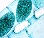 Συναγερμός στις ΗΠΑ για τον θανατηφόρο μύκητα Candida Αuris – Ποια είναι τα συμπτώματα