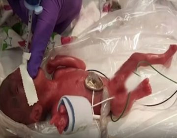 Tο μικρότερο μωρό στον κόσμο γεννήθηκε μόλις 245 γραμμάρια