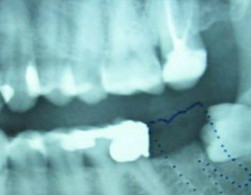 Απίστευτο περιστατικό: Δόντι μεγάλωνε στα γεννητικά όργανα 13χρονου