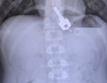 Ένιωθε έντονους πόνους στο στήθος, βρέθηκαν κλειδιά σφηνωμένα στον οισοφάγο του