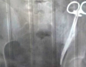 Είχε για 23 χρόνια ξεχασμένο στην κοιλιά της ένα χειρουργικό ψαλίδι