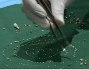 Γιατροί αφαίρεσαν από 7χρονο στην Ινδία 526 δόντια