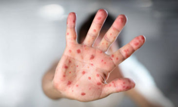 Έξαρση της ιλαράς παγκοσμίως – Κενά στην εμβολιαστική κάλυψη βλέπουν ΠΟΥ και Unicef