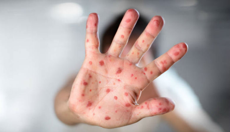Φόβος για τυχόν έξαρση της ιλαράς – Τα 6 μέτρα του υπουργείου Υγείας
