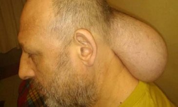 Κρατούμενος στις φυλακές Νιγρίτας με όγκο σε μέγεθος κεφαλιού