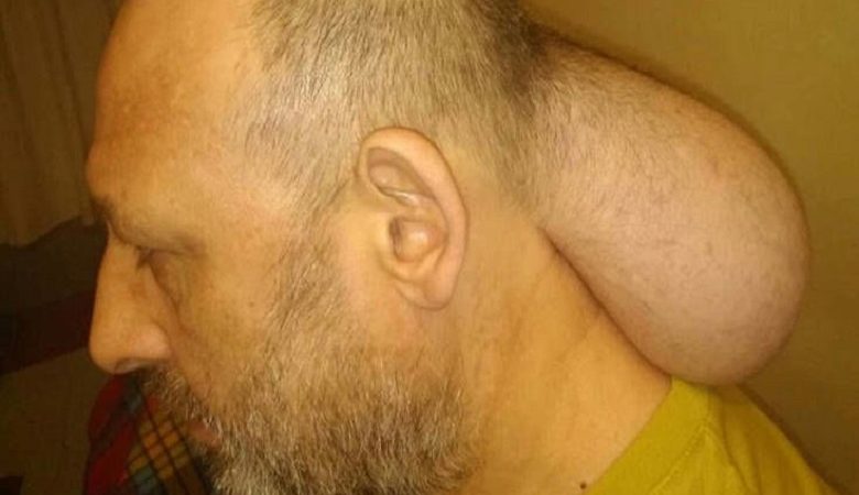 Κρατούμενος στις φυλακές Νιγρίτας με όγκο σε μέγεθος κεφαλιού