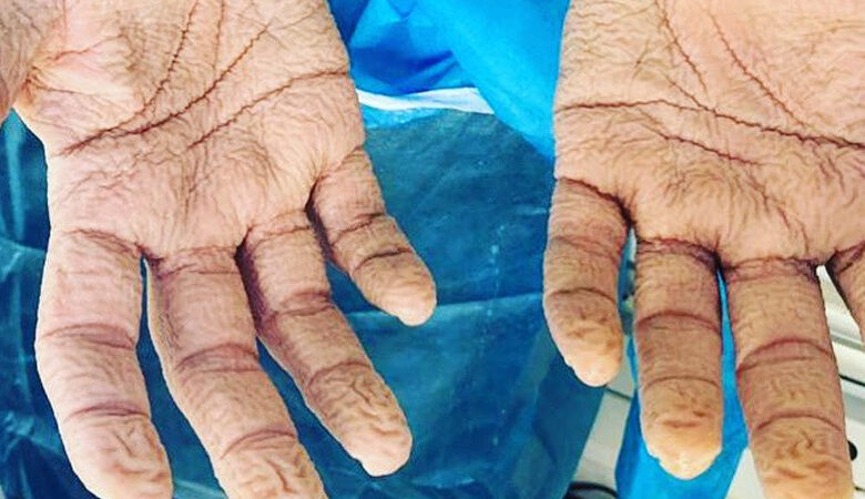 Συγκλονίζει η εικόνα με τα χέρια νοσηλευτή μετά από 8 συνεχόμενες ώρες διενέργειας τεστ