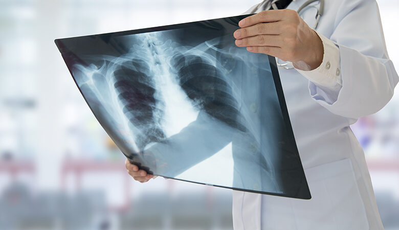 Καθηγητής Πνευμονολογίας προειδοποιεί για πιθανή έκρηξη φυματίωσης στη χώρα μετά την πανδημία