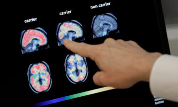 Αλτσχάιμερ: Ποια ερωτήματα προκύπτουν για το νέο φάρμακο που εγκρίθηκε στις ΗΠΑ