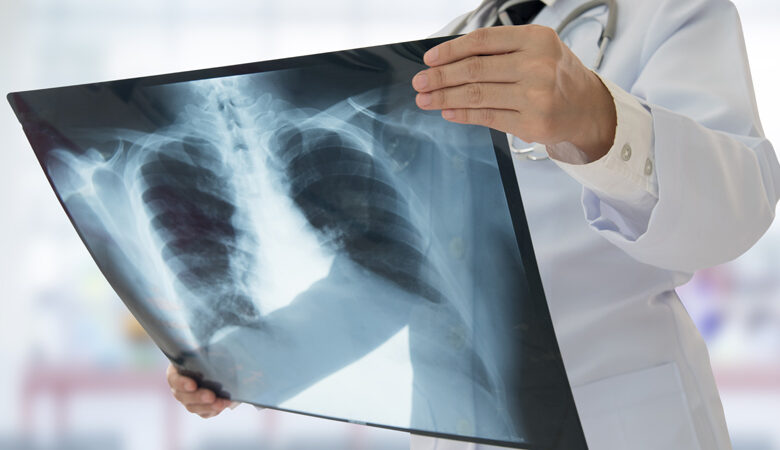 Κορονοϊός: Οι βλάβες στους πνεύμονες ανηλίκων που νόσησαν – Δείτε τις φωτογραφίες
