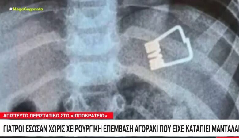 Θεσσαλονίκη: Γιατροί έσωσαν χωρίς χειρουργική επέμβαση αγοράκι που κατάπιε μανταλάκι