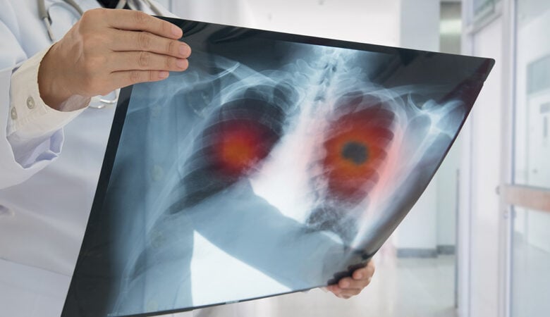 Καρκίνος του πνεύμονα: Μείωση των θανάτων κατά 25% αν εφαρμοστεί ο προσυμπτωματικός έλεγχος