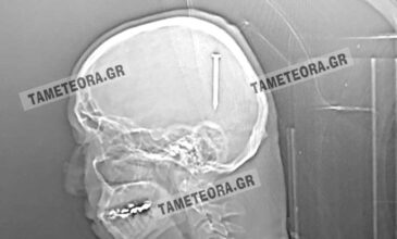 Καρφί 5 εκατοστών σφηνώθηκε στο κεφάλι ενός άνδρα στην Καλαμπάκα