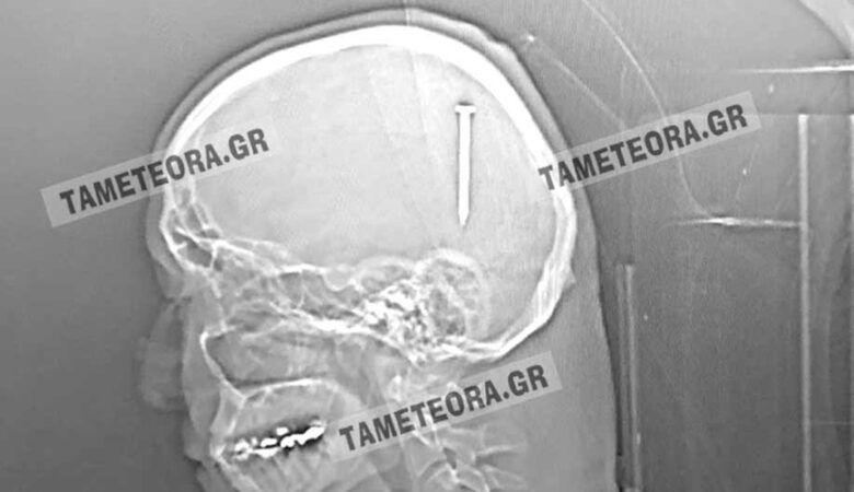 Καρφί 5 εκατοστών σφηνώθηκε στο κεφάλι ενός άνδρα στην Καλαμπάκα