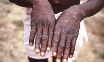 Ευλογιά των πιθήκων: Νέο «καμπανάκι» χτύπησε ο Παγκόσμιος Οργανισμός Υγείας