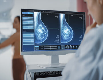 Τεχνητή νοημοσύνη: Πιο αποτελεσματική η χρήση της στη μαστογραφία για τη διάγνωση καρκίνου από δύο ακτινολόγους