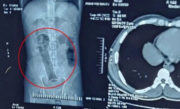 Δείτε τι είχε βάλει στον πρωκτό του ένας 27χρονος στην Ινδία – Αφαιρέθηκε χειρουργικά