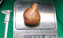 Έσπασαν το ρεκόρ Γκίνες αφαιρώντας μια τεράστια πέτρα 801 γραμμαρίων από τα νεφρά συνταξιούχου – Δείτε φωτογραφίες