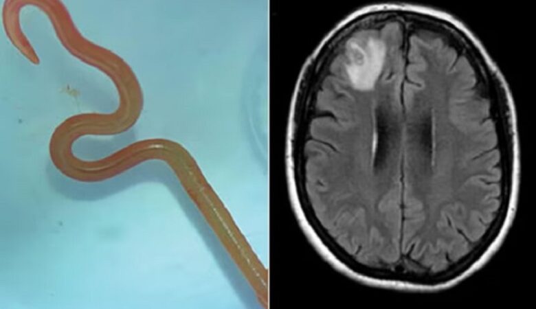 Ζωντανό σκουλήκι μήκους 8 εκατοστών βρέθηκε στον εγκέφαλο γυναίκας στην Αυστραλία