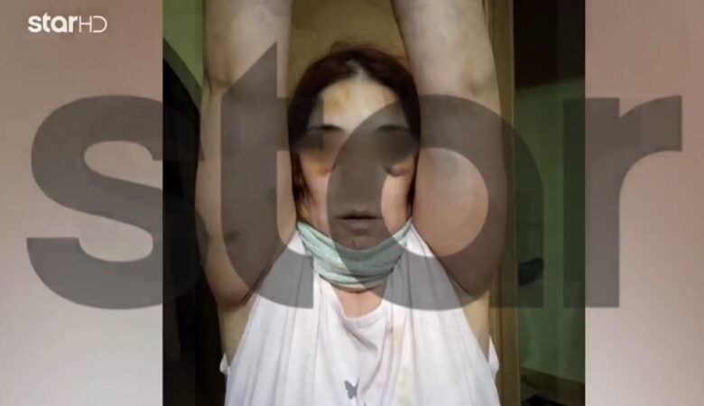 Σοκάρει η εικόνα της 32χρονης στο Άργος: «Με χτύπησε με το σίδερο στο πρόσωπο, μου είπε “θα σε σκοτώσω”»