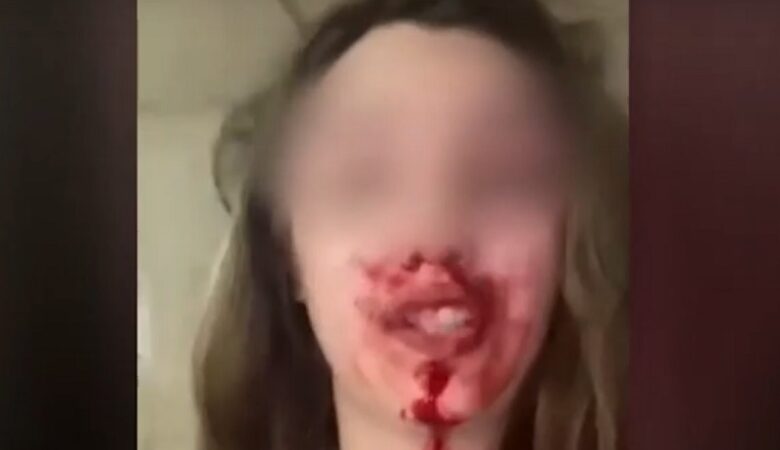 Θύμα ενδοοικογενειακής βίας κατήγγειλε σε βίντεο με αίματα στο πρόσωπο τον σύζυγό της