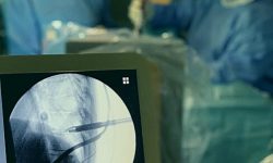Πρωτοποριακές Ενδοσκοπικές και Ελάχιστα Επεμβατικές Χειρουργικές Τεχνικές (MISS) για όλες τις παθήσεις της Σπονδυλικής Στήλης