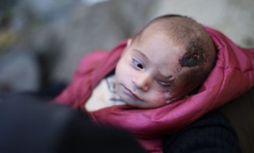 Το αγοράκι που έχασε το μάτι του σύμβολο του πολέμου στη Συρία