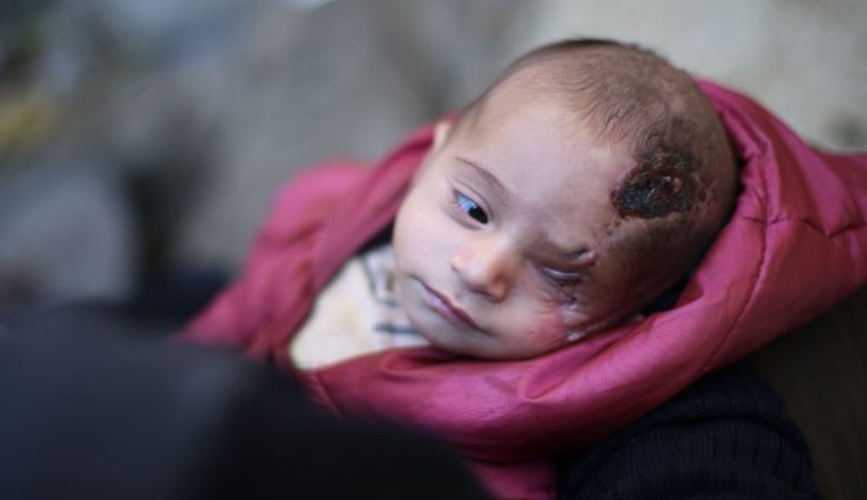 Το αγοράκι που έχασε το μάτι του σύμβολο του πολέμου στη Συρία