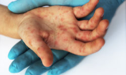 Πότε εκδηλώθηκαν τρεις επιδημίες ιλαράς στην Ελλάδα την τελευταία 10ετία