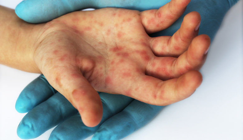 2.500 κρούσματα ιλαράς στην Ελλάδα μέσα σε ένα χρόνο